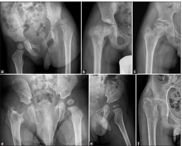 (a-f) The anteroposterior radiographs of the pelvis show a spectrum of post-infective sequel in various patients – (a) subluxation of the left hip joint due to capsular and ligament laxity, (b) coxa magna and breve of the right femur, (c) right hip joint arthritis with articular surface irregularity and small femoral head, (d) complete resorption of the right femoral head and neck, (e) avascular necrosis of the right femoral head and (f) complete ankylosis of the right hip joint.