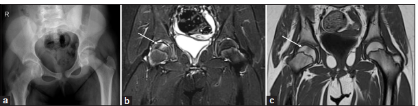 (a-c)An 11-year-old female child with pain and stiffness in the right hip for 2 months. (a) Anteroposterior pelvic radiograph shows mild narrowing of the medial right hip joint space and ipsilateral pelvis tilting. (b and c) Magnetic resonance imaging of pelvis – short-tau inversion recovery (STIR) and T1-weighted coronal images reveal a focal area of thinning of the articular cartilage with geographic edema of the underlying marrow (white arrow) in the middle one-third of the right proximal femoral epiphysis suggests idiopathic chondrolysis of the right hip joint. Minimal reactive right hip joint effusion is noted.