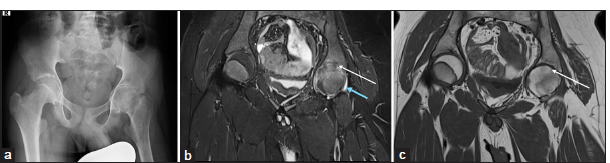 (a-c) A 13-year-old female child with left hip pain and stiffness for one year. (a) Anteroposterior pelvic radiograph shows concentric narrowing of the left hip joint space and ipsilateral pelvis tilting. (b and c) Magnetic resonance imaging of pelvis – short-tau inversion recovery (STIR) and T1-weighted coronal images demonstrate complete loss of articular cartilage with diffuse ill-defined edema of the femoral head and acetabulum and focal areas of fibrous ankylosis (thin white arrow). Minimal left hip joint effusion (blue arrow) is seen.