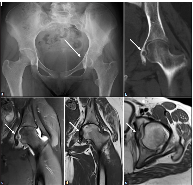 (a-g) Osteoid osteoma - A 14-year-old child with left hip pain and limp. (a) Anteroposterior pelvic radiograph shows a lytic lesion in the medial wall of the left acetabulum with cortical thickening and benign periosteal reaction (long white arrow). (b) Computed tomography coronal image shows a lytic lesion in the medial wall of the left acetabulum with cortical thickening (white arrow). (c-e) Magnetic resonance imaging of pelvis – short-tau inversion recovery and T1-weighted coronal and T2 axial shows an isointense to the hypointense lesion with cortical thickening (white arrow) in the left medial wall of the left acetabulum with associated reactive bone marrow edema and mild left hip joint effusion and synovitis.