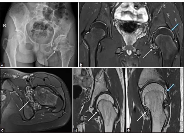 (a-e) A 13-year-old male child with left hip pain and limp for three years. (a) Anteroposterior pelvic radiograph shows numerous ossified loose bodies (thin white arrow) in the left hip joint with juxtaarticular osteopenia, widening of the acetabular roof and coxa magna. (b-e) Magnetic resonance imaging of pelvis – (b and c) short-tau inversion recovery coronal and axial, (d) T1-weighted coronal, and (e) proton density sagittal images demonstrate numerous ossified loose bodies (white arrow in b-e), thinning of the articular cartilage and erosions of the femoral head (blue arrow in b and e).