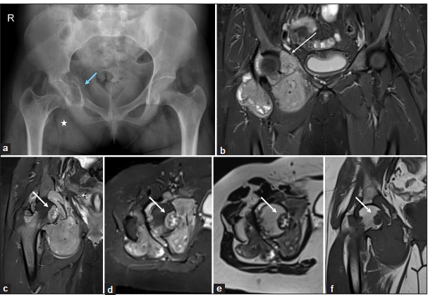 (a-f) A 20-year-old lady with right hip pain. (a) Anteroposterior pelvic radiograph shows increased soft tissue opacity (white asterisk) in the right hip joint with erosions of the femoral head and acetabulum and mild expansion of the acetabulum (blue arrow). (b-f) Magnetic resonance imaging of pelvis – (b-d) short-tau inversion recovery coronal and axial, (e) T2-weighted axial, and (f) T1w coronal images show nodular synovial proliferation with characteristic T2 low signal intensity with erosions of the femoral head (white arrow in c-f) and erosions of the acetabulum (long white arrow in b).