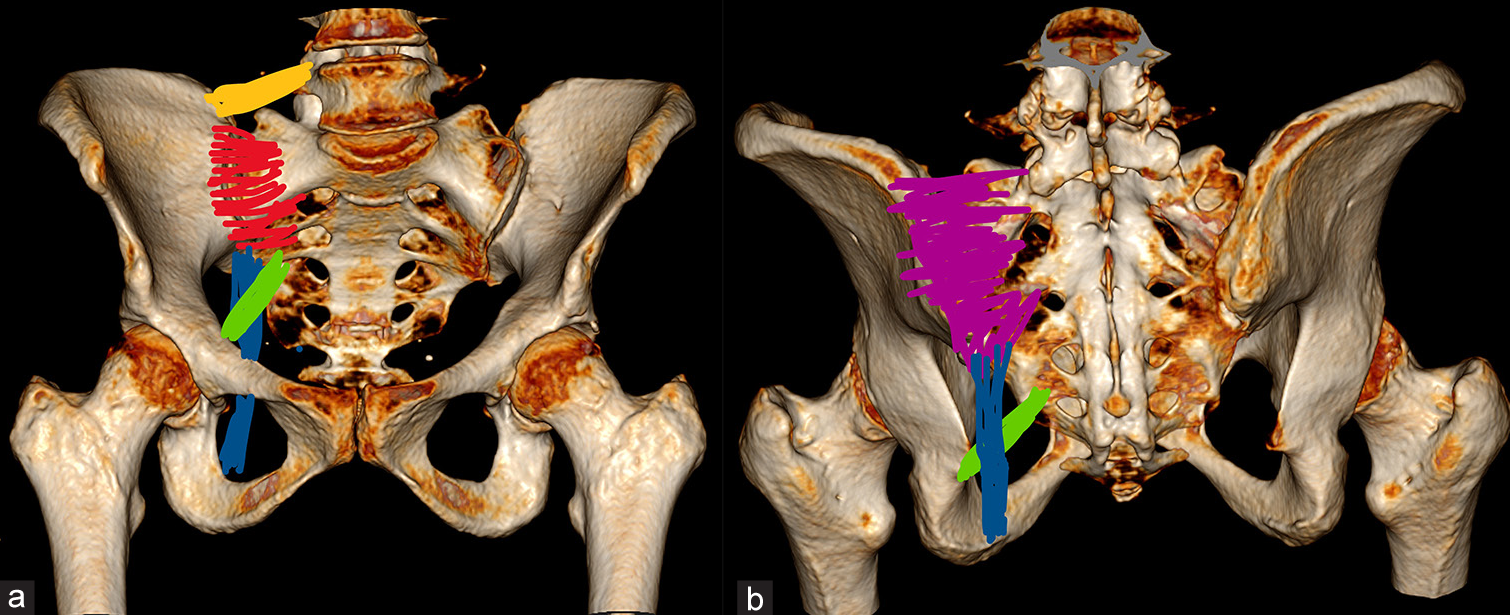 (a and b) Represent 3D image of pelvic bones with anterior sacroiliac ligaments (red), posterior sacroiliac ligaments (pink), iliolumbar ligaments (yellow), sacrotuberous ligament (blue), and sacrospinous ligaments (green).