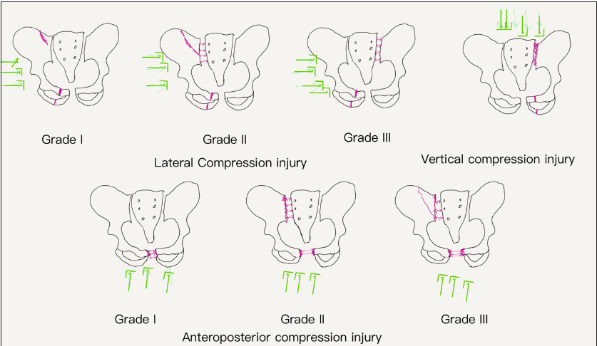 Line diagram of classification of pelvic injuries which is based on the type of impact (green arrows) and resultant fractures (pink lines). The double-headed pink arrows represent diastasis. LC: Lateral compression, AP Grad: Anteroposterior compression grade