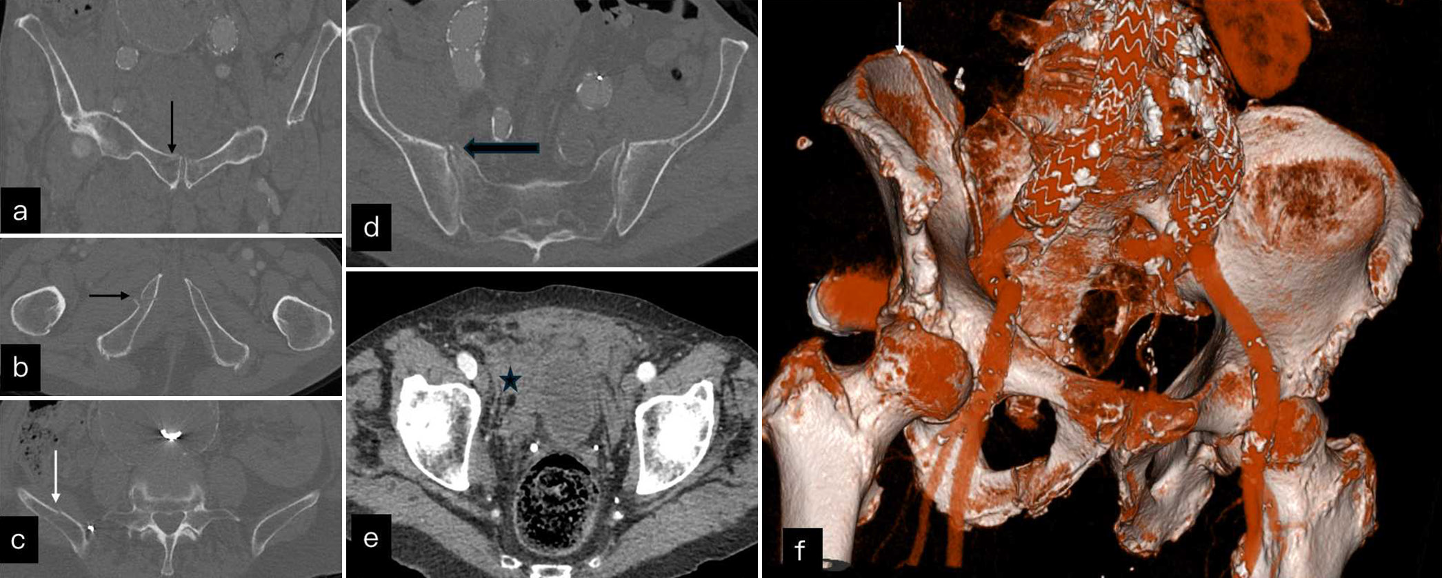 (a) Non-contrast computed tomography (NCCT) pelvis coronal and (b,c) axials show undisplaced superior and inferior pubic rami fractures (black arrow) and undisplaced iliac wing fracture (white arrow). (d) Axial NCCT images show undisplaced subarticular fracture (black block arrow) without any diastasis. (e) Soft tissue window show extraperitoneal hematoma (black star) surrounding the bladder. (f) A 3D reconstruction image shows undisplaced iliac wing fracture (white arrow). No diastasis is seen suggesting stable type I injury.