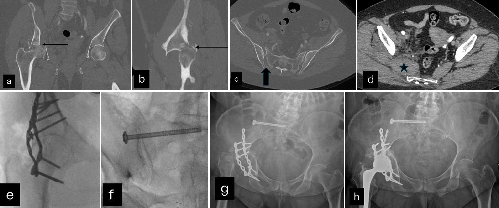 (a and b) Coronal and sagittal reformats of NCCT show comminuted displaced acetabular fracture (black arrow) with posterior femoral displacement. (c) Shows diastasis of right sacro-iliac joint (black block arrow) and chip fracture of ilium. (d) Axial soft tissue window shows right pyriformis hematoma (black star). (e and f) Intra operative fluoroscopy images where unstable acetabular and posterior ring fracture were fixed internally. (g) Post operative X rays shows lysis of femoral head. (h) Post operative radiographs shows subsequent arthroplasty done with right femoral head prosthesis.