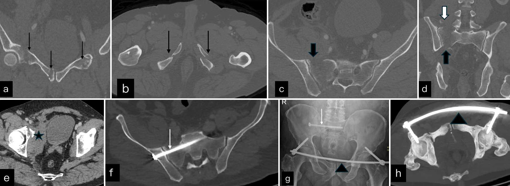 (a and b) Non-contrast computed tomography coronal and axial images show displaced superior and inferior pubic fracture (black arrows). (c and d) Axial and coronal through the sacrum show zone I sacral fracture with significant diastasis (black block arrow) and avulsed fracture of transverse process (white block arrow). (e) Axials soft tissue window show pelvic hematoma (black star). This is a type III injury. (f) and (g ) Axial post operative CT and radiographs show internal fixation screws (white arrow) and temporary external fixator (black arrow head). (h) Axial CT shows temporary external fixator (black arrow head).