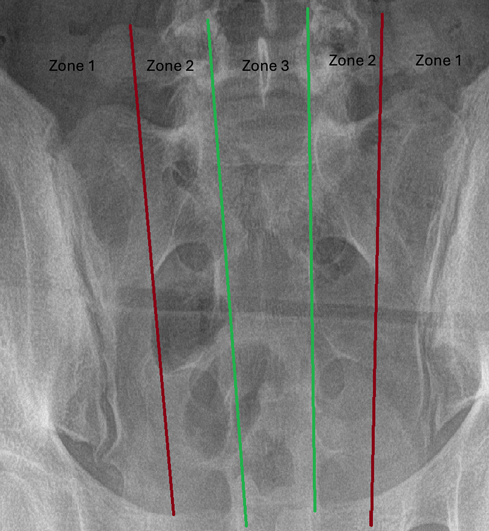 Sacrum radiograph divided by four imaginary lines into three zones. The zone lateral to the red lines on each side represents zone 1. The area between green and red lines on each side represents zone 2 which contains sacral foramina and area between two green lines represents zone 3 which contains central canal.