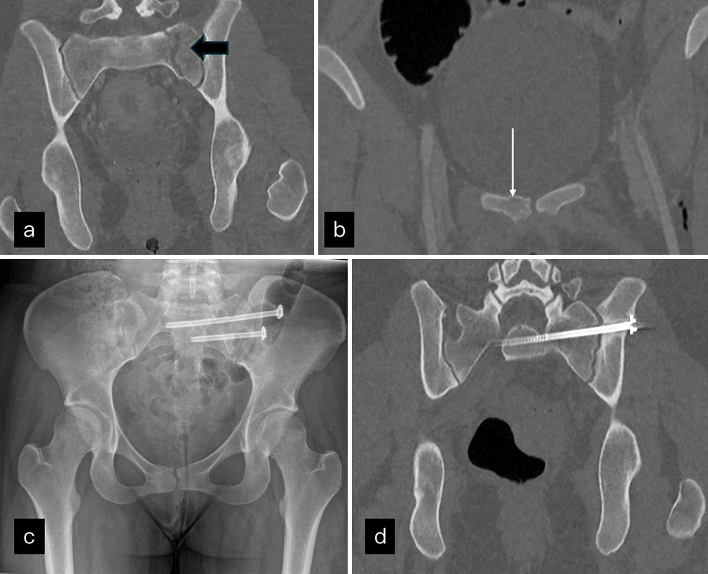 (a and b) Coronal imagest of CT shows a zone 2 sacral fracture (black block arrow) through left sacral ala with mild diastasis associated with undisplaced superior pubic fracture (white arrow) in (b). (c) Post operative radiograph and (d) non contrast computed tomomography pelvis shows intramedullary nails across the SI joint and complete healing of the fracture.