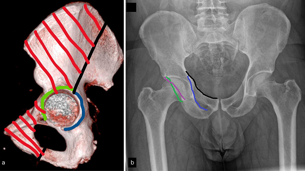 (a) 3D reconstructed image of hemipelvis where green line represents anterior wall, blue line posterior wall, shaded red area anterior column, and unshaded area posterior column. (b) A pelvis anteroposterior radiograph with black line representing iliopectineal line, purple line representing ilioischial line, green line representing anterior acetabular wall, and blue line representing posterior acetabular wall. Any discontinuity in the above-mentioned lines on radiograph is sign of acetabular fracture.