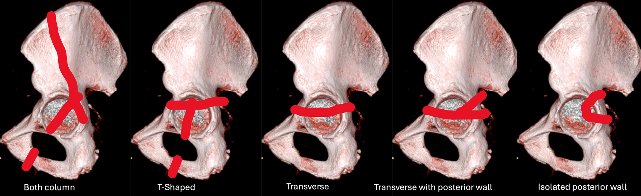 Representation of the five types of acetabular fracture pattern on 3D hemipelvis.