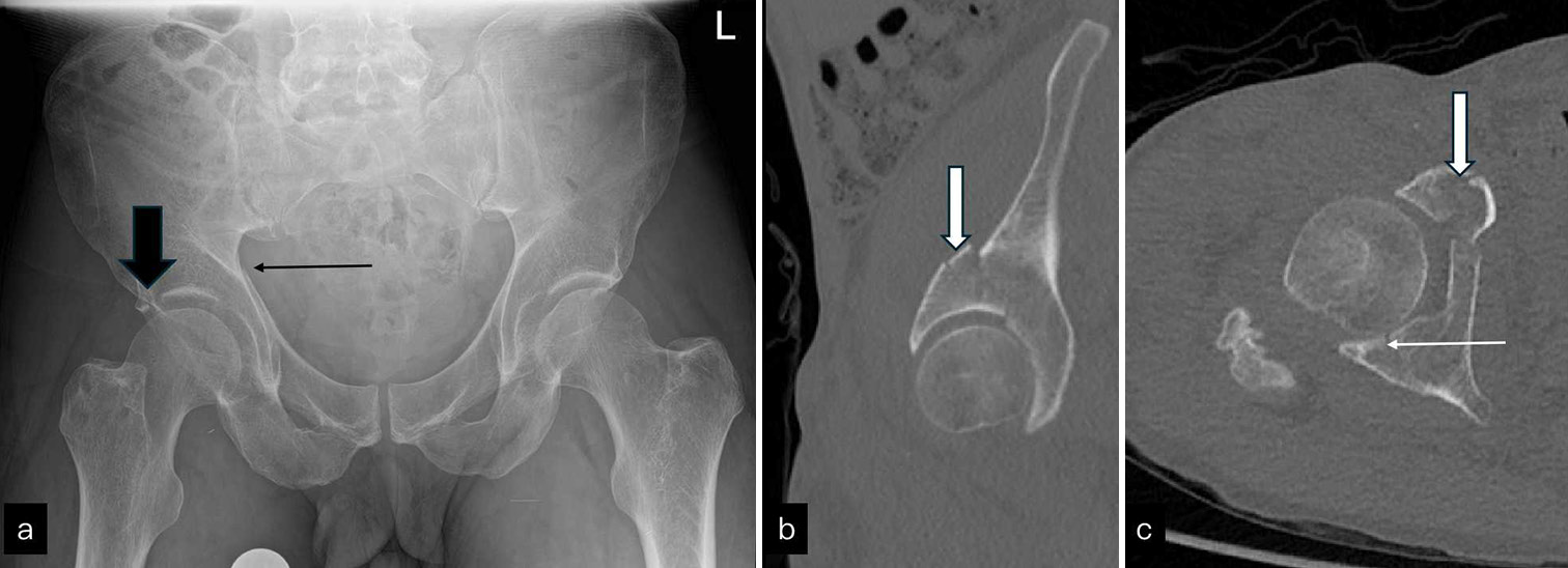 (a) AP radiograph of pelvis shows break in iliopectineal (long black arrow) and roof of acetabulum (black block arrow). (b) Sagittal non-contrast computed tomography images show minimally displaced anterior column fracture (white block arrow in b and c). (c) shows undisplaced posterior wall fracture (white arrow). AP: Anterior posterior