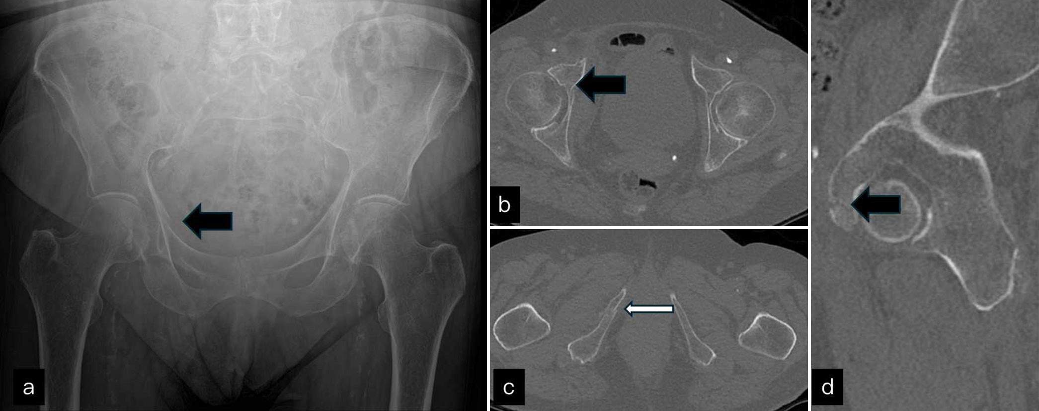 (a) Anteroposterior pelvis radiograph shows a break in iliopectineal line (black block arrow) on right side. (b-d) non-contrast computed tomography axial images through hip joint and inferior pubic ramus and sagittal images show pubic fracture (black block arrow) which extends to involve anterior wall of acetabulum on sagittal image and undisplaced inferior pubic ramus fracture (white arrow). This can be treated conservatively.