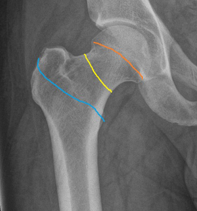 Anteroposterior radiograph of right hip joint shows three types of femoral neck fracture. The orange line represents subcapital, yellow line represents mid cervical, and blue line represents intertrochanteric fracture.