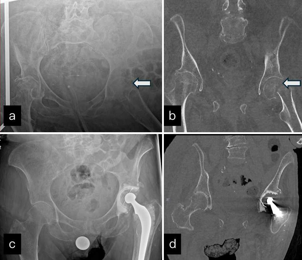 (a-d) Anteroposterior radiograph of pelvis (a) and non-contrast computed tomography coronal images (b) demonstrate minimally displaced subcapital fracture (white block arrow) which was treated with femoral head replacement (c and d).