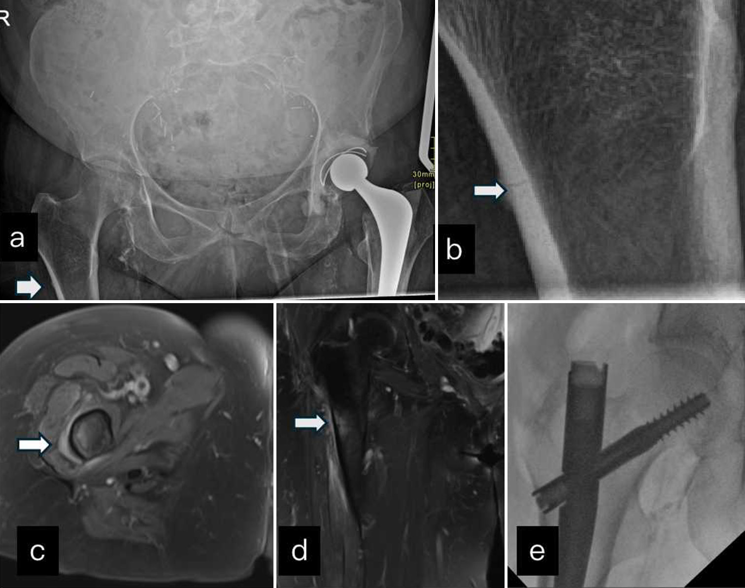 (a) AP radiograph shows focal cortical bulge in proximal lateral femoral cortex (white block arrow). (b) Zoomed in image shows horizontal lucency and periosteal reaction (white block arrow) in keeping with atypical femoral fracture. (c and d) T2FS axial and coronal MRI shows periosteal edema along lateral femoral cortex and marrow edema (white block arrow). (e) Intraoperative fluoroscopic images show prophylactic intramedullary nailing done for this fracture. AP: Anteroposterior