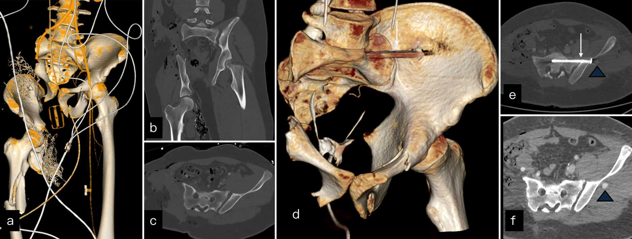 A young cyclist was runover by a tractor. (a) 3D reconstruction shows displaced right hemipelvis and femur shaft fracture. (b and c) The coronal and axial images show degloving injury of right lower limb and diastasis of left sacroiliac joint (SIJ). (d) 3D reconstructed image shows right hemipelvectomy and lower limb amputation done with internal fixation screw (white arrow) across left SIJ. (e and f) Follow up contrast scan shows iatrogenic aneurysm (blue arrow head) post internal fixation.