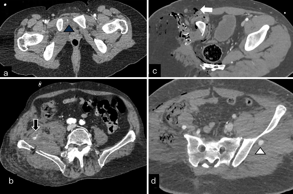 Vascular injuries: (a) Axial images contrast CT show small contrast blush (blue arrow head) surrounding the pubis. (b) Axial images show comminuted iliac fracture with surrounding hematoma with active contrast extravasation (white block arrow) suggesting traumatic psueodaneurysm. (c) Axial CT in degloving injury of lower limb shows complete thrombus of femoral vessels (black arrow). (d) Post operative images show iatrogenic aneurysm (white arrow head) in left gluteal region. CT: Computed tomography