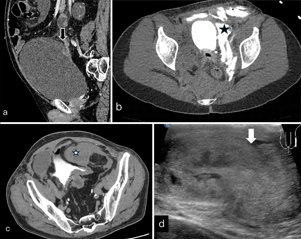 (a) Sagittal soft tissue window show overdistended urinary bladder with large defect in dome of bladder (black block arrow). (b) Axial delayed images show hyperdense ascites (white star) suggesting intraperitoneal bladder rupture. (c) Axial post contrast delayed CT of another patient show extravasation of contrast in extra-peritoneal space (black star) and subcutaneous tissue of abdominal wall suggesting extra-peritoneal bladder rupture. (d) Ultrasound images of scrotum show large testicular hematoma with altered contour (white block arrow) in keeping with testicular rupture. CT: Computed tomography