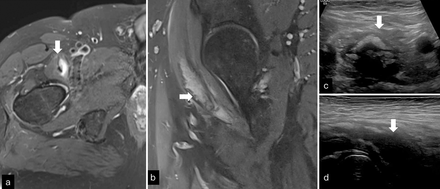 (a and b) Axial and coronal T2FS images through right hip shows intrasubstance collection (white block arrow) within iliopsoas suggesting partial tear. (c and d) Short axis and long axis ultrasound images of iliopsoas show hypoechoic collection with calcification (white block arrow).