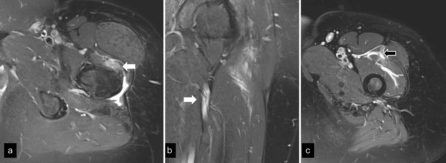 (a-c) Axial and coronal T2 fat saturated images through thigh show irregularity of vastus origin (white block arrow) from femur and intramuscular edema (black block arrow) within the axial images through distal thigh.