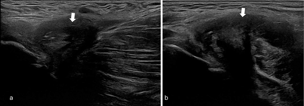 (a) and (b) Short axis and long axis ultrasound images through adductor origin show intramuscular hematoma (white arrow).