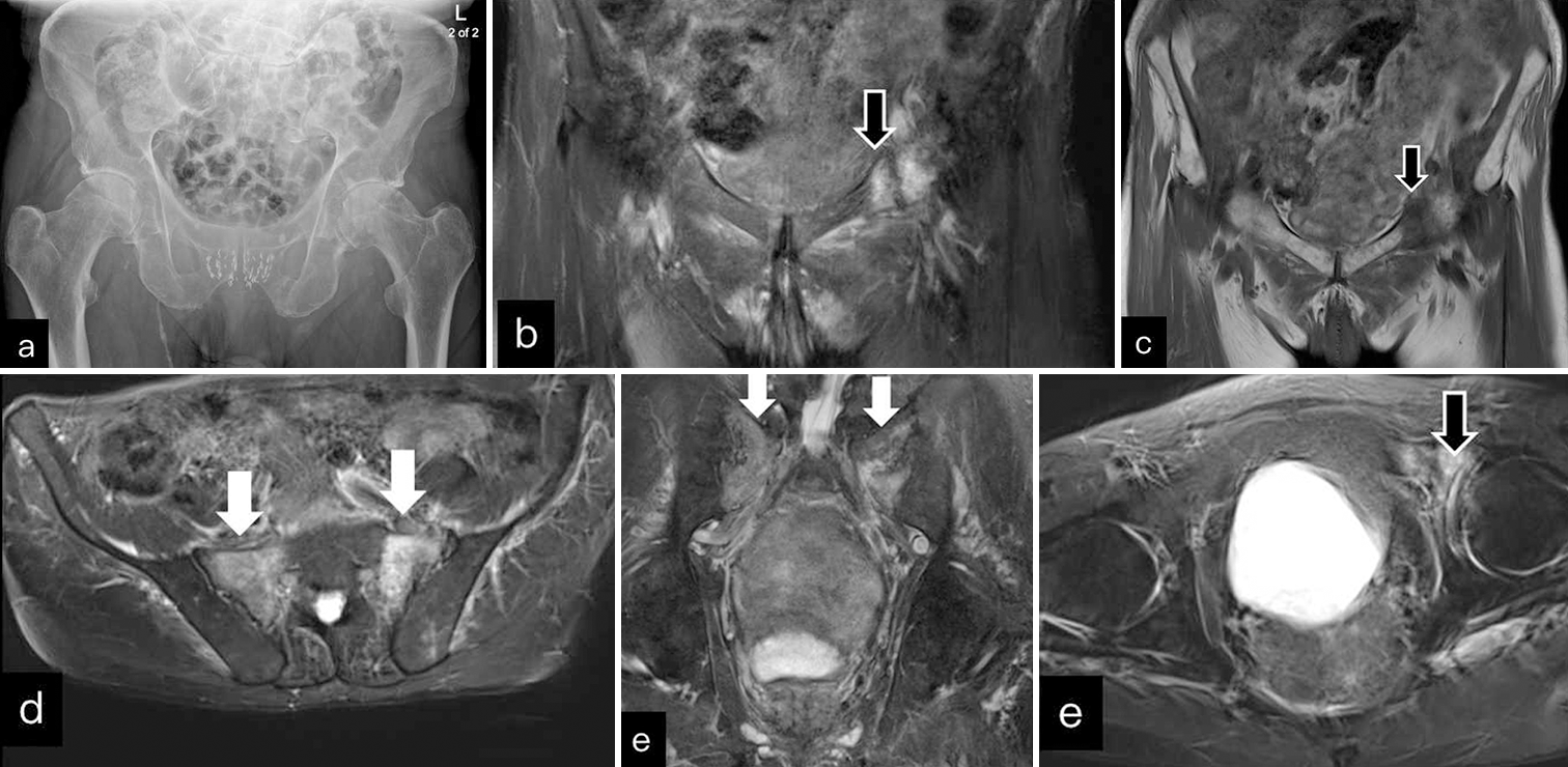 An elderly patient presented with fall. (a) AP radiograph was unremarkable. (b and c) Coronal T2 fat saturated (FS) and T1WI images show undisplaced left superior pubic ramus fracture (black block arrow). (d and e) Axial and coronal T2FS show extensive bilateral sacral edema with hypointense line (white block arrows) in keeping with sacral insufficiency fracture. (f) Axial T2FS image show undisplaced left superior pubic ramus fracture (black block arrow) with surrounding edema. AP: Anteroposterior