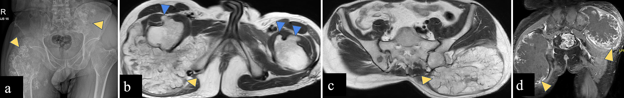 (a-d) A 37-year-old male with diaphyseal aclasis and secondary chondrosarcoma. (a) Anterior-posterior radiograph of the pelvis reveals large soft tissue masses with rings and arc matrix mineralization involving proximal metadiaphysis of the right femur and left iliac blade (yellow arrowheads). (b and c) Axial T2-weighted magnetic resonance images reveal T2 hyperintense lobulated masses (yellow arrowheads) arising from right femur and left iliac blade, and post-contrast T1-weighted MR image (d) reveals peripheral nodular and septal pattern of enhancement of these masses consistent with chondrosarcoma (yellow arrowheads). Bony outgrowths are seen arising from bilateral femoral necks (blue arrowheads in d) with marrow continuity consistent with osteochondromas.