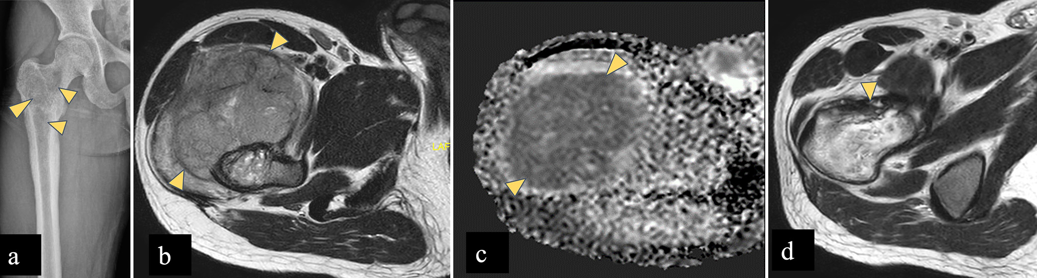 (a-d) A 25 year male with Ewing’s sarcoma. (a) AP radiograph of the right femur shows permeative pattern of bone destruction with wide zone of transition and without any matrix mineralisation in right femoral neck, greater trochanter, intertrochanteric region extending to proximal diaphysis (yellow arrowheads). (b) Axial T2-W MR image shows heterogeneous marrow signal intensity in right femoral neck with extra-osseous soft tissue component (yellow arrowheads) showing intermediate signal. (c) Apparent diffusion coefficient (ADC) shows signal drop (yellow arrowheads) suggestive of diffusion restriction, which signifies malignant etiology. (d) Post neoadjuvant chemotherapy, axial T2-W MR image shows regression of soft tissue component. (yellow arrowhead) AP: Anterior-posterior