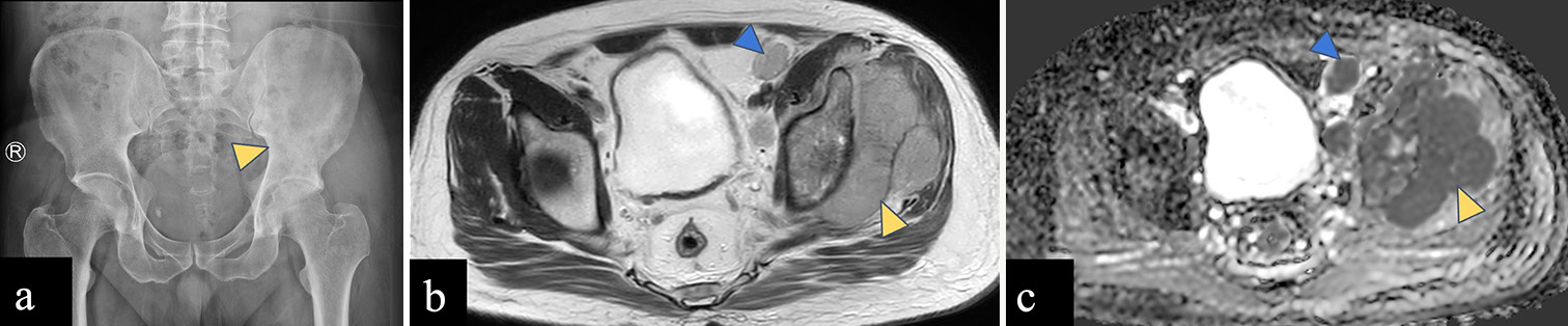 (a-c): A 44-year-old male with lymphoma. (a) Anterior posterior radiograph of the pelvis reveals ill-defined sclerosis in the left iliac bone and acetabulum (yellow arrowhead) with wide zone of transition. (b) Axial T2-weighted magnetic resonance image shows altered marrow signal intensity involving the left iliac bone with associated extraosseous soft tissue component (yellow arrowhead). (c) Apparent diffusion coefficient (ADC) image shows homogeneous signal drop in soft tissue (yellow arrowhead) suggestive of diffusion restriction. Enlarged left external iliac lymph nodes (blue arrowhead in b) showing ADC drop (blue arrowhead in c) suggestive of metastatic nodes.