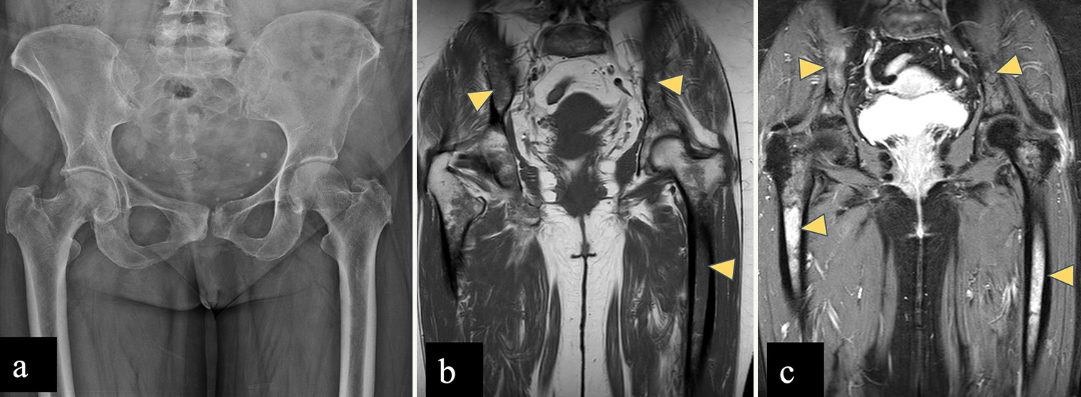 (a-c): A 66-year-old male with multiple myeloma. (a) Anterior posterior radiograph of the pelvis reveals mild osteopenia with degenerative bilateral trochanteric enthesopathic changes. (b) Coronal T1-weighted image shows diffusely hypointense marrow signal in left femoral diaphysis and bilateral iliac bones (yellow arrowheads), hypointense to muscle. (c) STIR coronal image reveals hyperintense marrow signal intensity involving femoral diaphysis and bilateral iliac bones (yellow arrowheads). STIR: Short tau inversion recovery.