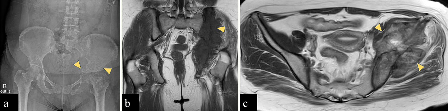 (a-c): A 29-year-old woman with an osteosarcoma of the left iliac wing. (a) Anterior posterior radiograph of the pelvis reveals ill-defined lytic lesion with wide zone of transition involving the left iliac bone and acetabulum (yellow arrowheads) without any matrix mineralization. (b) Coronal T1-weighted magnetic resonance (MR) image shows hypointense marrow in left hemipelvis with associated soft tissue component (yellow arrowhead) (c) Axial T2-weighted MR image shows intermediate signal intensity mass arising from left iliac bone with associated soft tissue component (yellow arrowheads) reaching up to the subarticular surface of the left sacroiliac joint without involving it.