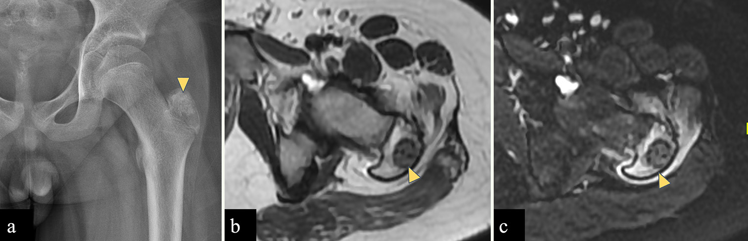 A 12 years old male child with left femoral chondroblastoma. (a) Radiograph of left femur shows a well-defined lesion with narrow zone of transition showing chondroid matrix (yellow arrowhead) in greater trochanter of an immature skeleton. (b) Axial T2-W MR image shows a well defined T2 hypointense lesion in the left femoral greater trochanter (yellow arrowhead). (c) STIR axial images show perilesional marrow edema which signifies inflammation surrounding the tumor (yellow arrowhead). Imaging findings consistent with chondroblastoma.