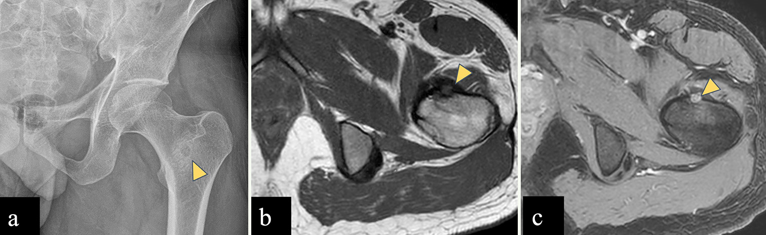 (a-c) A 30-year-old male with left femoral intertrochanteric osteoid osteoma. (a) Anterior posterior radiograph of the pelvis reveals lucent central nidus with peripheral sclerosis in left femoral intertrochanteric region (yellow arrowhead). (b) Axial T1-weighted (T1-W) magnetic resonance (MR) image shows hypointense lesion (yellow arrowhead) arising from anterior cortex of left femoral intertrochanteric region. (c) Dynamic post-contrast T1-W MR image shows enhancing central nidus (yellow arrowhead).