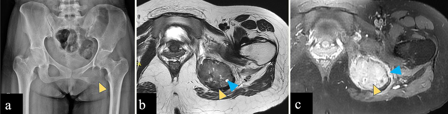 (a-c) A 23-year-old female with giant cell tumor of left ischial tuberosity. (a) Anterior posterior radiograph of the pelvis reveals an expansile lytic lesion in the left ischial tuberosity with a narrow zone of transition (yellow arrowhead). (b) Axial T2-weighted magnetic resonance (MR) image shows a T2 intermediate expansile lesion in the left ischial tuberosity (yellow arrowhead) with few small hyperintense cysts within (blue arrowhead). (c) Post-contrast T1-weighted MR image shows homogeneous enhancement of the left ischial tuberosity lesion (yellow arrowhead) with perilesional edema (blue arrowhead). No associated soft tissue component is seen.