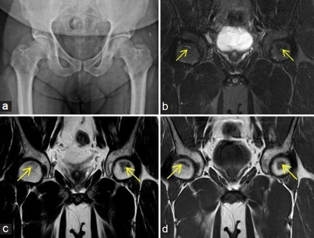 (a-d) A 48-year man with pain at both hips. (a) Frontal radiograph of pelvis with both hips shows near normal appearance of both femoral heads. In view of high clinical suspicion, an magnetic resonance imaging was performed. (b) Coronal fluid sensitive fat sat, (c) T2W Spin-Echo (SE) images, and (d) T1W SE coronal images depict small geographic areas of early stage of osteonecrosis (yellow arrows in b - d) at anterosuperior aspects of both femoral heads.