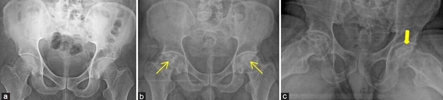 (a-c) A middle aged man with hip pain and history of steroid usage for COVID. (a) Initial frontal radiograph of pelvis with both hips was presumed to be normal. One and a half year later, due to persistent episodes of pain, radiographs were repeated. (b) Frontal projection shows irregular bordered geographic lesions with mixed sclerotic areas at bilateral femoral heads consistent with avascular necrosis (yellow arrows) and early articular surface collapse. (c) Frog leg view demonstrates the “crescent sign” at the left femoral head which is depicted as curvilinear subarticular lucent fracture line (thick yellow arrow).