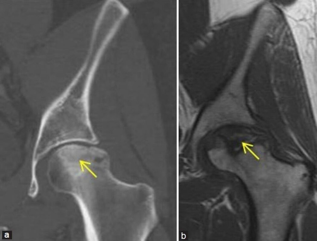 (a and b) Young man with the left hip pain. (a) Coronal computed tomography reformatted image of the left hip in bony window settings demonstrates irregular bordered sclerotic area at the left femoral head consistent with osteonecrosis (yellow arrow). Articular surface collapse of head is well delineated. (b) Corresponding coronal T1-weighted magnetic resonance image of the left hip of the same patient better depicts the femoral head osteonecrosis and collapse (yellow arrow), suggesting Ficat and Arlet stage 3.