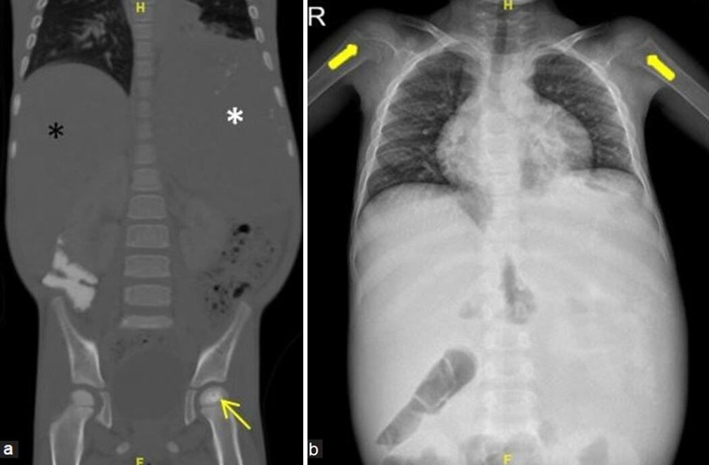 (a and b) A young boy with episodes of the left hip pain and abdominal fullness. (a) Coronal computed tomography reformatted image of abdomen and pelvis in bony window settings demonstrates sclerosis and irregularity of the left femoral head epiphysis consistent with osteonecrosis (yellow arrow). Enlarged liver (black asterisk) and spleen (white asterisk) are also depicted well. (b) Frontal radiograph of chest and abdomen shows enlarged soft-tissue density shadow at the right and left hypochondriac regions, consistent with hepatosplenomegaly. Widened metaphysis of proximal humeri are also noted (thick yellow arrows). This is a worked up case of Gauchers disease.