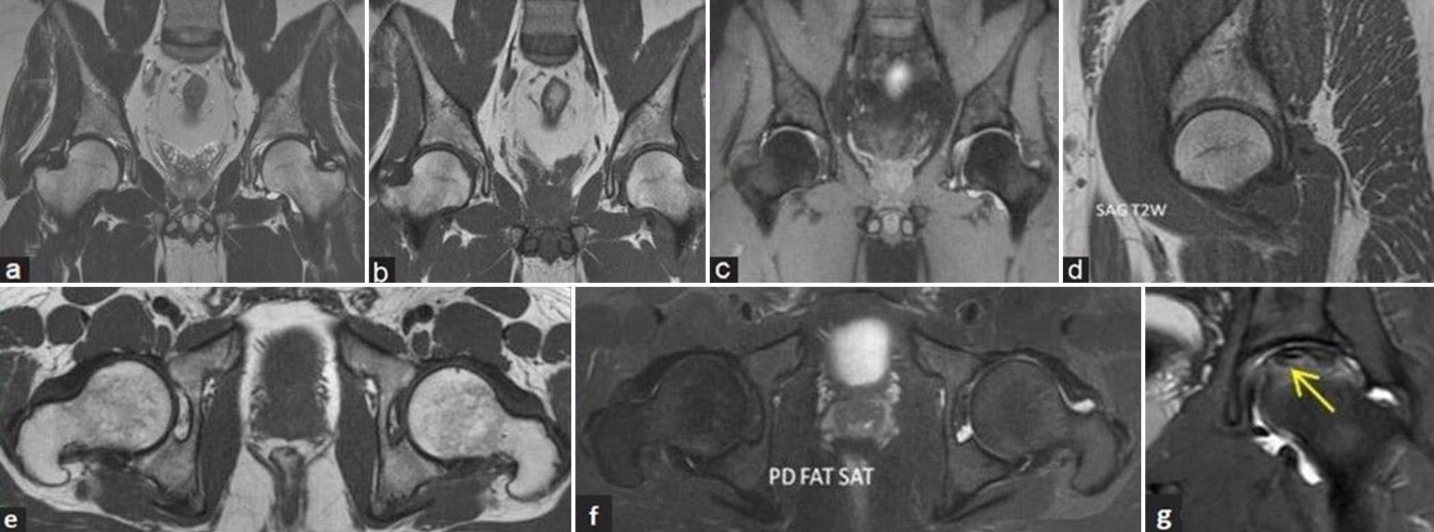 (a-g) Magnetic resonance (MR) imaging protocol and sequences. (a) Coronal T2-weighted image (T2WI), (b) T1-weighted image (T1WI), and (c) fluid sensitive fat sat (short-tau inversion recovery) MR images of pelvis with both hip joints in a young man showing the area of coverage to include both the hips. (d) Sagittal T2WI MR image of the right hip, (e) axial T1WI, and (f) fluid sensitive proton density (PD) fat sat MR images of both hips depicts the normal morphology of hips. (g) Coronal fluid sensitive PD fat sat MR image of the left hip in another middle aged man showing small field of view coverage depicting osteonecrosis of the left femoral head (yellow arrow).