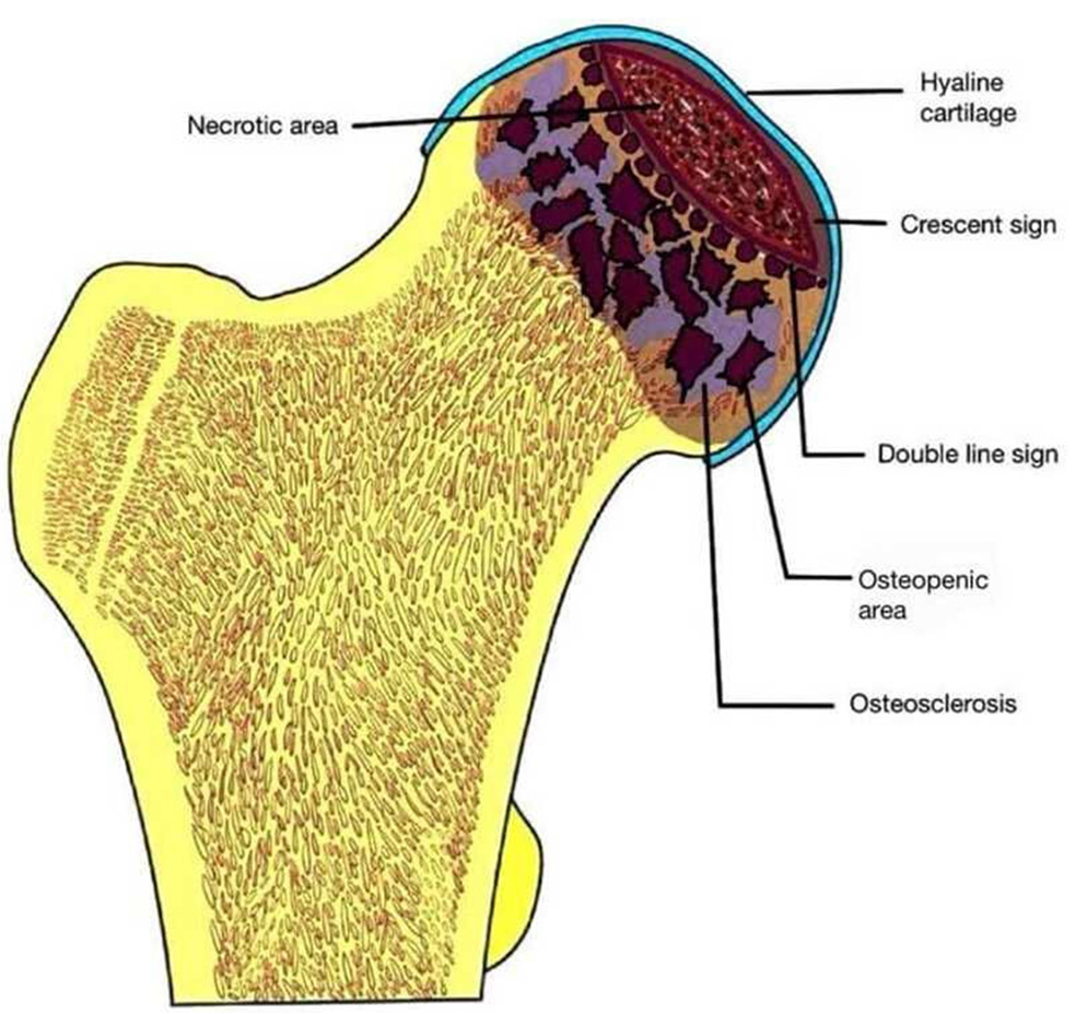 Schematic diagram depicting the various features of osteonecrosis of femoral head.