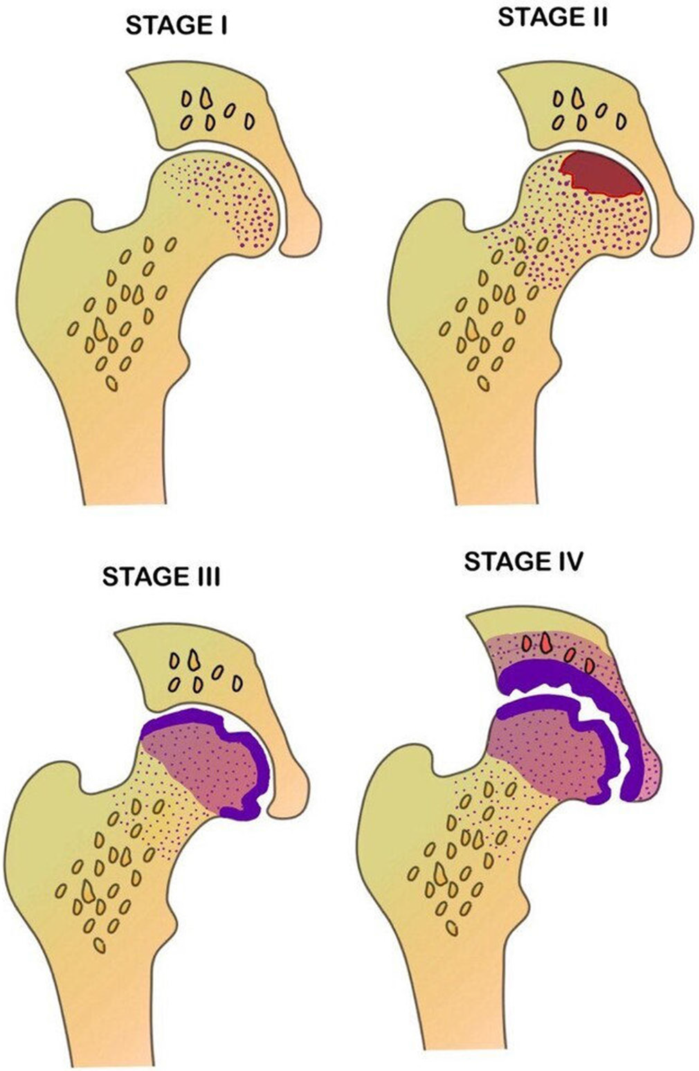 Schematic diagram depicting the various stages of osteonecrosis based on modified Ficat and Arlet staging.