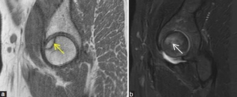 (a and b) Stage 1 avascular necrosis (Ficat and Arlet): (a) Sagittal T1-weighted image magnetic resonance (MR) image in a young man showing single hypointense line (yellow arrow) at anterosuperior aspect of femoral head with (b) bone marrow edema (white arrow) better depicted on the sagittal fat sat MR image.