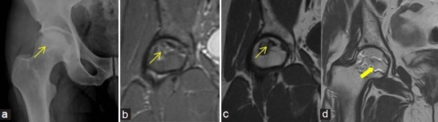 (a-d) Stage 2 avascular necrosis (Ficat and Arlet): (a) Frontal radiograph of the right hip in a 47-year man shows geographic lesion with sclerotic margin (yellow arrow) at femoral head. (b) Coronal Proton density fat saturated image and (c) T1-weighted image magnetic resonance (MR) images also demonstrate similar findings of geographic lesion (yellow arrows). (d) Coronal T2-weighted image MR images in a different patient depict the classical appearance of “Double-line sign” (thick yellow arrow) at the right femoral head with inner bright and outer dark lines.