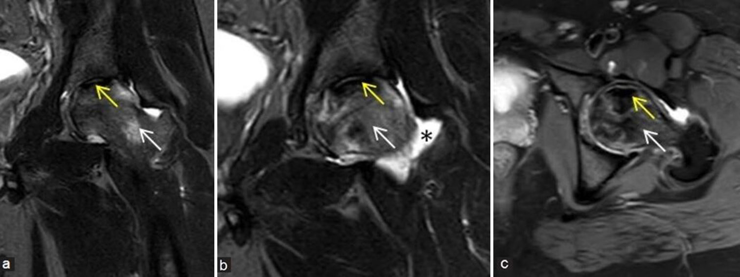 (a-c) Precollapse or impending collapse: (a and b) Coronal and (c) axial fluid sensitive short-tau inversion recovery magnetic resonance images of the left hip in a young man demonstrate avascular necrosis (yellow arrows) at left femoral head with prominent edema pattern (white arrows) at femoral head and neck regions with associated mild left hip joint effusion (black asterisk), findings suggesting impending collapse. These findings also correlate with a painful hip and indicates poor prognostic feature.