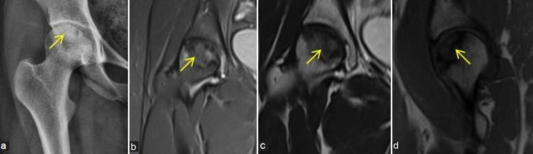 (a-d) Stage 3 avascular necrosis (Ficat and Arlet): (a) Frontal radiograph of the right hip in a 24-year young girl shows geographic lesion with sclerotic margin at femoral head (yellow arrow) with associated early cortical collapse. (b) Coronal proton density fat sat, (c) T2-weighted image, and (d) sagittal T1-weighted image images also demonstrate similar findings (yellow arrows).