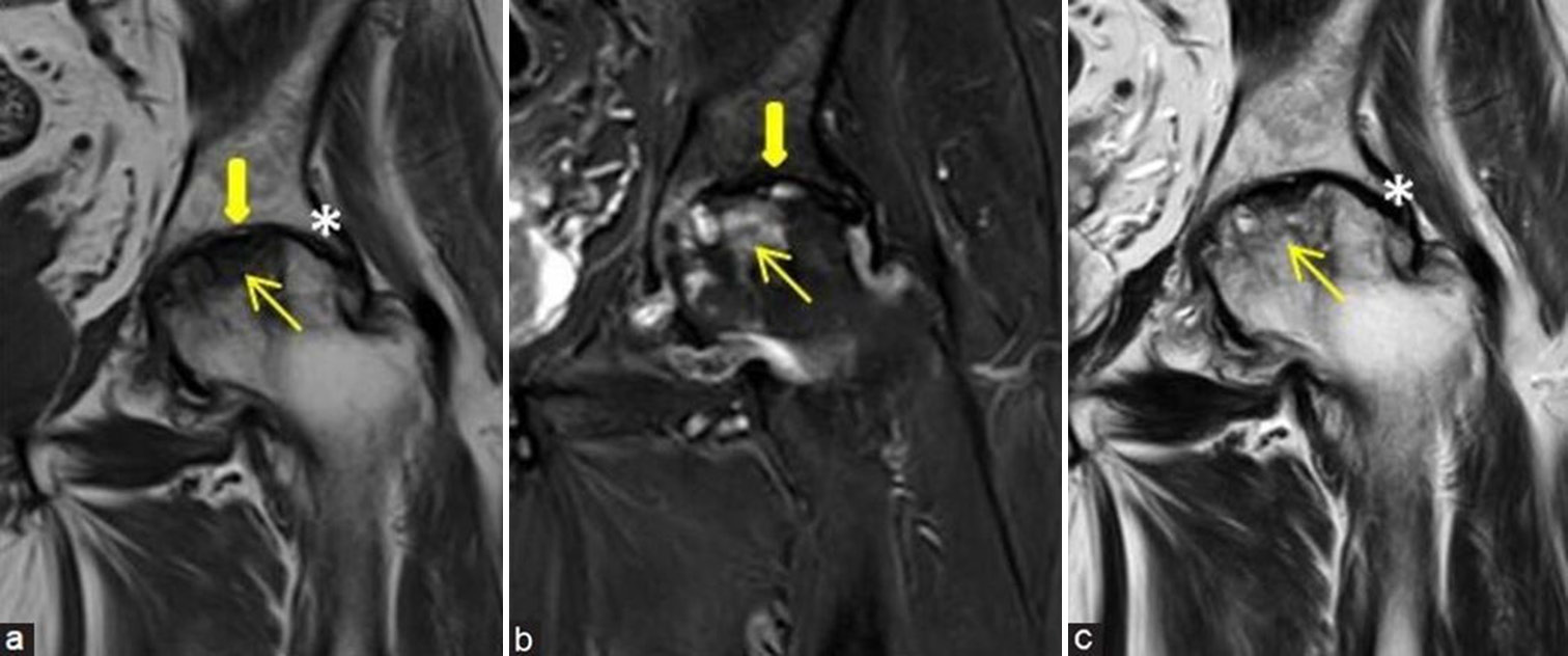 (a-c) Stage 4 avascular necrosis (Ficat and Arlet): (a) Coronal T1-weighted image, (b) short-tau inversion recovery, and (c) T2-weighted image magnetic resonance images of the left hip of a middle aged man shows evident collapse of femoral head (yellow arrows) with secondary degenerative arthritis of the left hip showing subarticular cysts, reduced joint space (thick yellow arrows), cartilage loss, and marginal osteophytes (white asterisk in a and c).