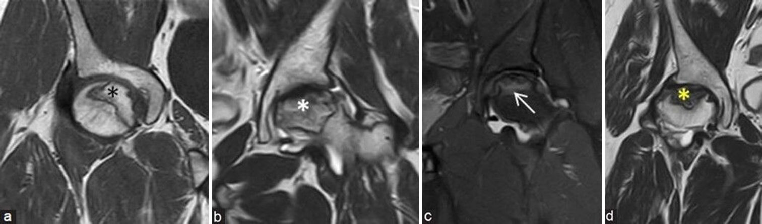 (a-d) Mitchells magnetic resonance imaging (MRI) staging depends on the signal intensity of osteonecrosis core: (a) Coronal T1-weighted image MRI of the right hip in a young man shows hyperintense fatty signals (fat: stage A) (black asterisk), (b) coronal T2-weighted image (T2WI) MRI of the left hip in a middle aged man shows intermediate and hyperintense T2 signals (blood: stage B) (white asterisk), (c) coronal short-tau inversion recovery MRI of the left hip in a young man shows hyperintense edematous signals (fluid: stage C) (white arrow), and (d) coronal T2WI MRI of the right hip in a middle aged man shows hypointense T2 signals (fibrous: stage D) (yellow asterisk).