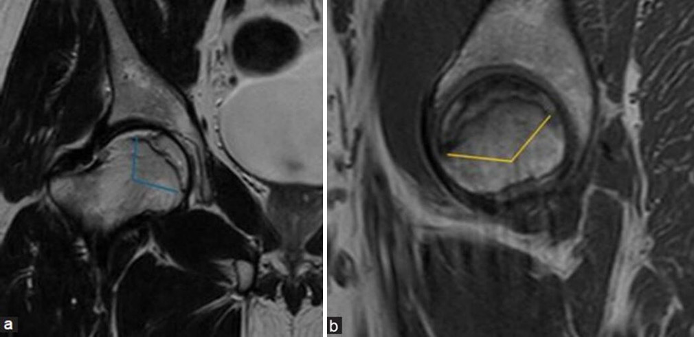 (a and b) Modified Kerboul angle/combined necrotic angle: This measurement is done by adding arc of femoral head osteonecrosis on a (a) mid-coronal and (b) mid-sagittal image. It is used to assess the risk of head collapse where an angle <190 degrees indicates low-risk group, 190 to 240 degrees indicates moderate risk group, and more than 240 degrees indicates high risk for collapse.