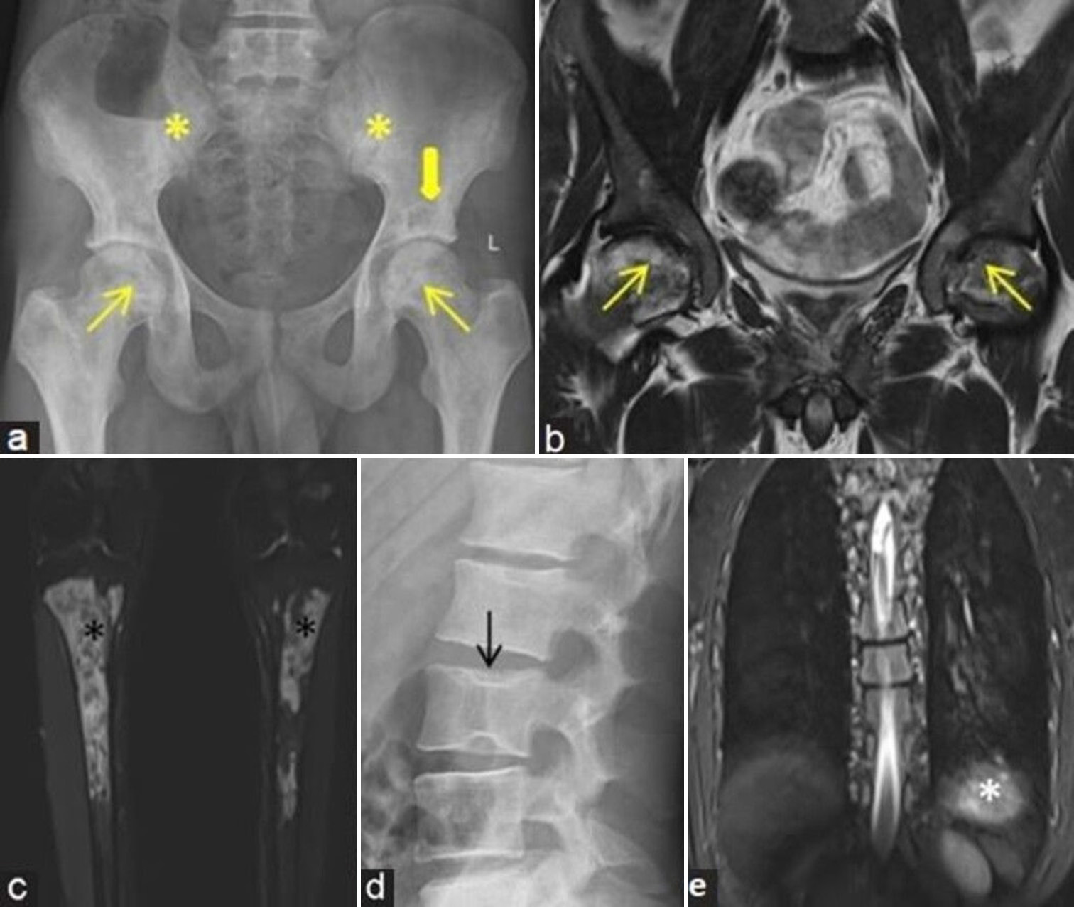 (a-e) A young man with pain at both hips. (a) Frontal radiograph of pelvis with both hips shows irregular bordered geographic lesions with lucent areas at bilateral femoral heads (yellow arrows) and also along the acetabular margins (thick yellow arrow). Patchy sclerosis also noted at bilateral sacroiliac joints (yellow asterisks). (b) Coronal T2-weighted image magnetic resonance (MR) image demonstrates osteonecrosis at bilateral femoral heads (yellow arrows). (c) Coronal fluid sensitive fat sat (Short-tau inversion recovery [STIR]) MR images of both legs demonstrate medullary bone infarcts in bilateral tibia at proximal and middle third regions (black asterisks). (d) Lateral view radiograph of lumbar spine depicts mild depression of central plateau with “H”-shaped appearance in mid lumbar vertebra (black arrow). (e) Coronal long Field of view STIR MR image of dorsolumbar region depicts small sized spleen (white asterisk). All these features represent spectrum of findings in a patient with sickle cell anemia.